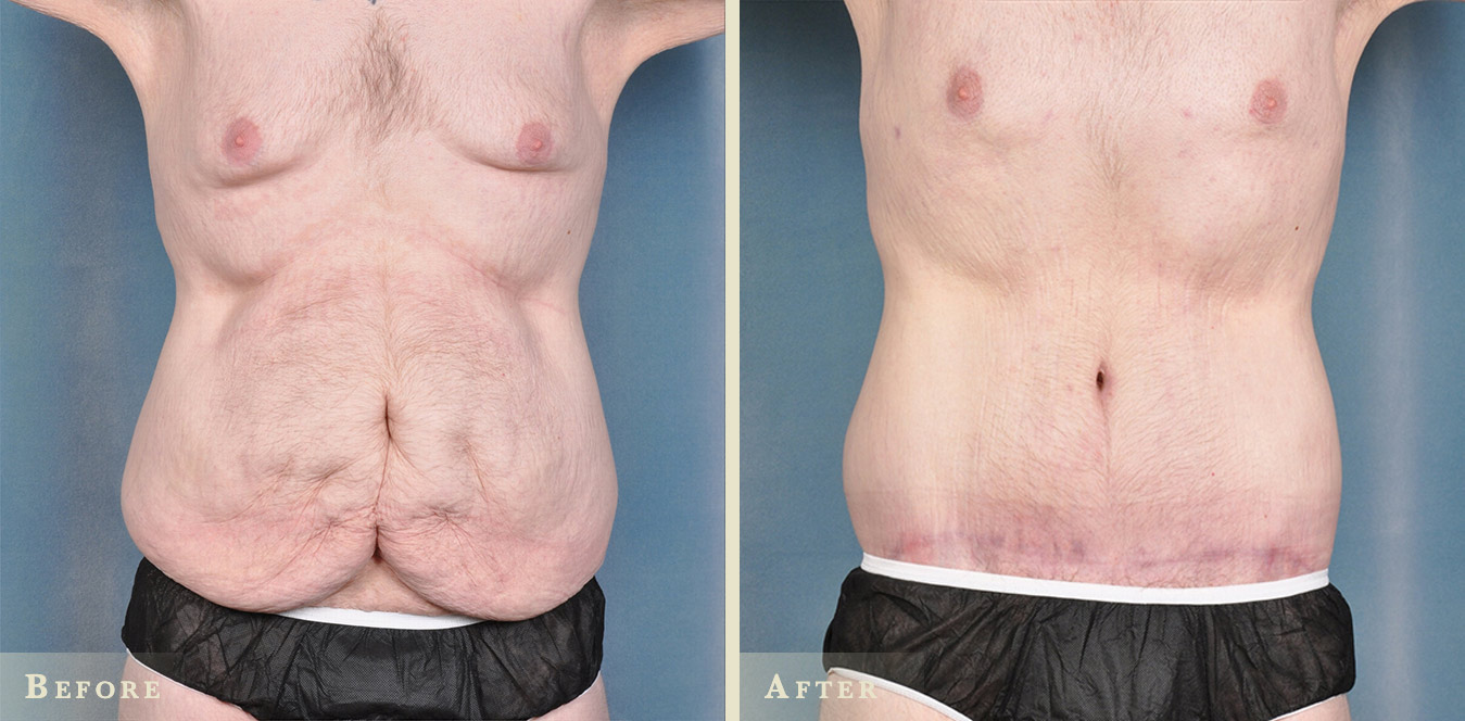 Patient before (left) and after (right) undergoing an upper body