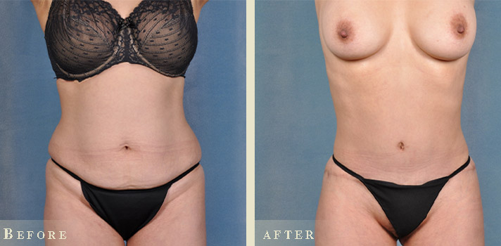 Feel Your Best this Swimsuit Season with a Tummy Tuck - Nicholas