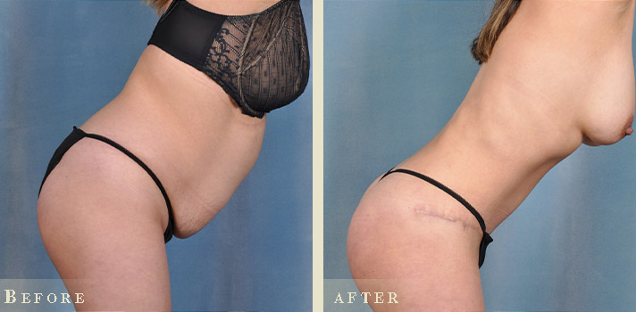 39 F After Tummy Tuck with Lipo 360