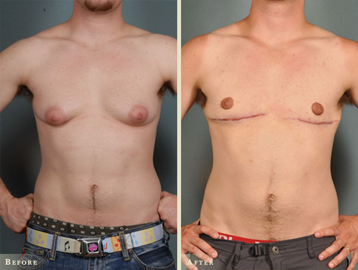 Increase in men with man boobs having breast reduction surgery