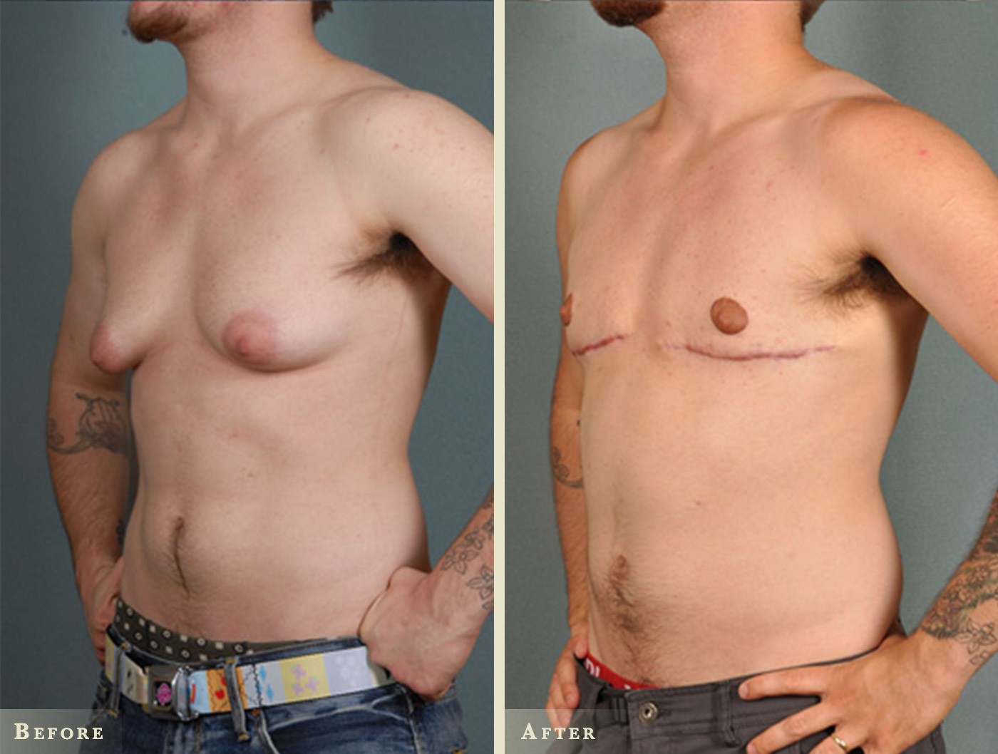 Male Breast Reduction Before And After Colorado Plastic Surgery