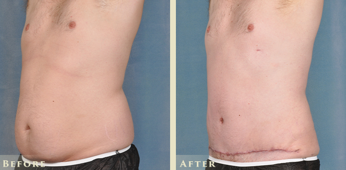 Stomach liposuction: cost, procedure, results before and after